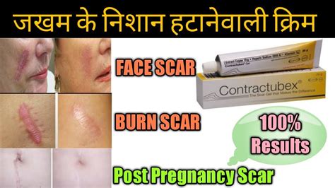 Contractubex Gel review! पुराने से पुराने scars, Marks को जड़ से मिटा ...