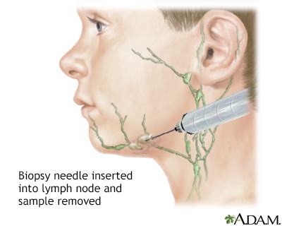 Lymph node culture Information | Mount Sinai - New York