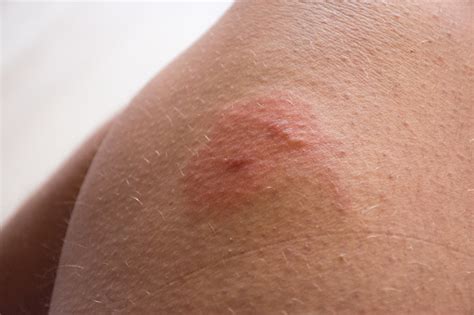 Photo Of Insect Bite On Skin Double Insect Bite With Redness Inflammation Area And Allergic ...