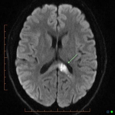 Splenium of corpus callosum acute infarction - posterior pericallosal ...