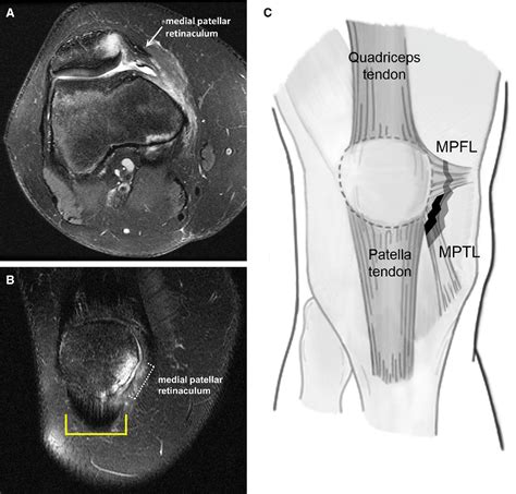 Medial Patellar Retinaculum Injury