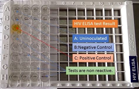 HIV ELISA: Introduction, Principle, Procedure, Result Interpretation