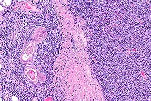 Thymoma - Libre Pathology