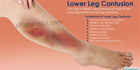 Lower Leg Contusion|Symptoms|Treatment|Stretching, Strengthening Exercises|Sports Massage