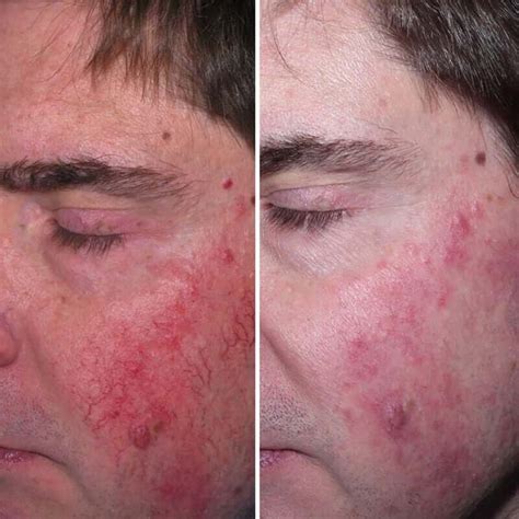 Rosacea Treatment | Before & After | Kingsway Dermatology