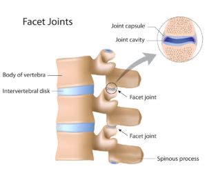 Facet Hypertrophy Symptoms, Diagnosis, Treatment | AllSpine