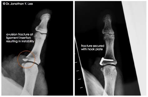 Avulsion Fracture Finger