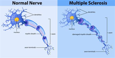 Normal nerve and multiple sclerosis 294059 Vector Art at Vecteezy