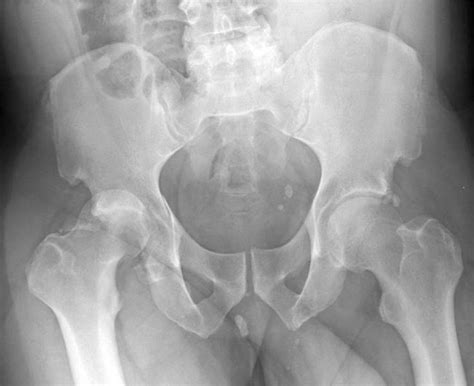 Hip Dislocations, Femoral Head Fractures, and Acetabular Fractures | Musculoskeletal Key