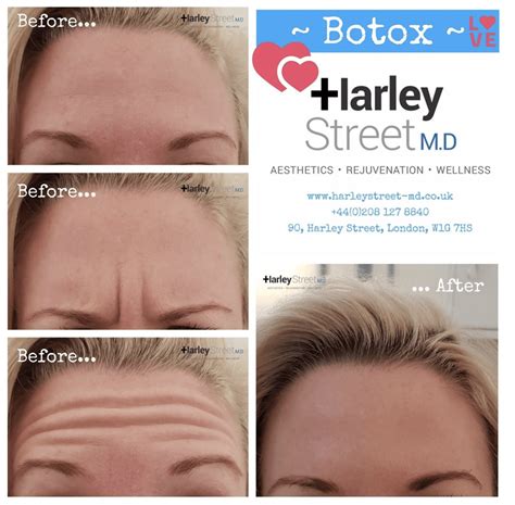 Botox in London | Harley Street MD