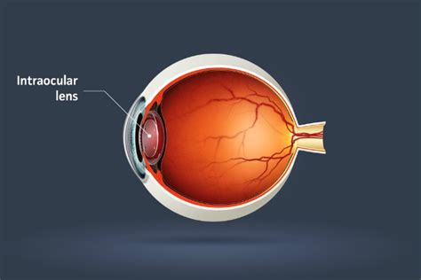 What is an intraocular lens? | Clinica London