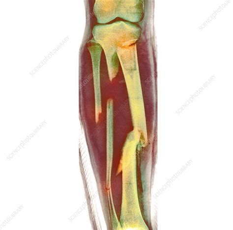 Fractured leg, X-ray - Stock Image - F037/8134 - Science Photo Library