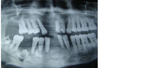 Intra Oral Approach for Complex & Compound Odontomas (Large or Small)