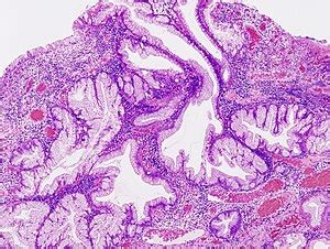 Hyperplastic polyp of the stomach - Libre Pathology