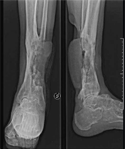 Osteomyelitis Histology