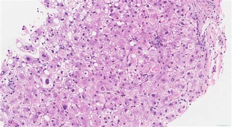 Alpha-1 antitrypsin deficiency | Ottawa Atlas of Pathology