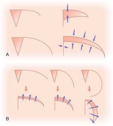 Rotation Flaps | Plastic Surgery Key