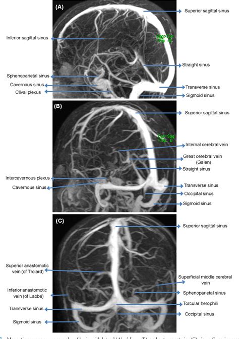 Figure 5.1 from DURAL VENOUS SINUSES | Semantic Scholar