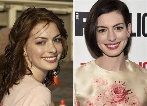 Anne Hathaway Before and After Plastic Surgery: Boobs, Nose, Face, Lips