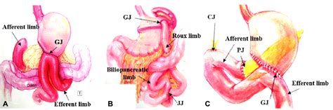 Common surgically altered anatomy (SAA). (A) Billroth II anatomy... | Download Scientific Diagram