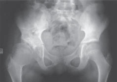 Seven-year-old female with mild right-sided limp. The AP pelvis x-ray ...