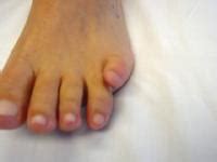 Overlapping Toe - Pediatrics - Orthobullets