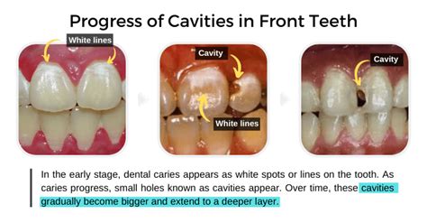 Front Tooth Cavity