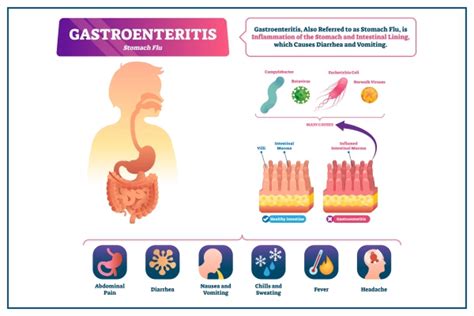 Gastroenteritis - JeeshanYakub
