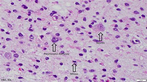 Diffuse Astrocytoma Idh Mutant Grade 2 - tiktoktoktok