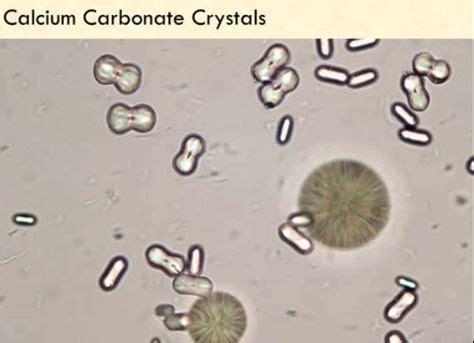 8 Calcium carbonate crystals in urine ideas | طب