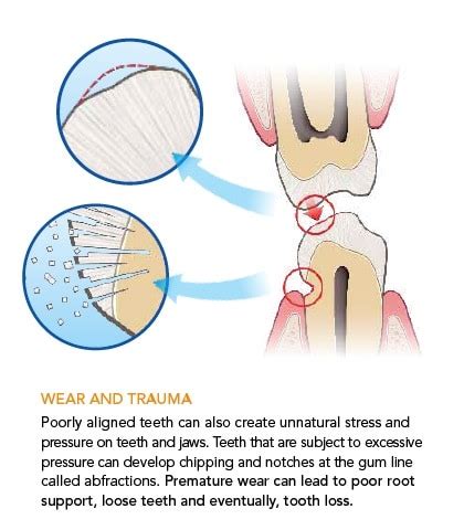 Tooth Abfraction Treatment