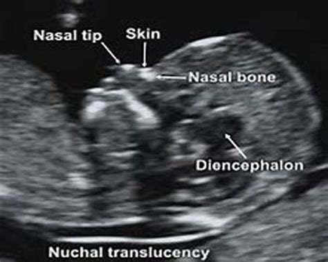 Nuchal Translucency Test - A Specialized Routine Ultrasound – The ...