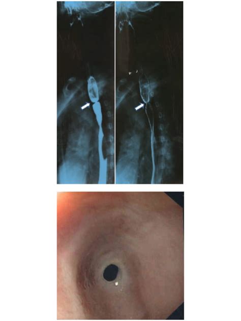 Esophageal Web in a Child | International Journal of Clinical & Medical Images