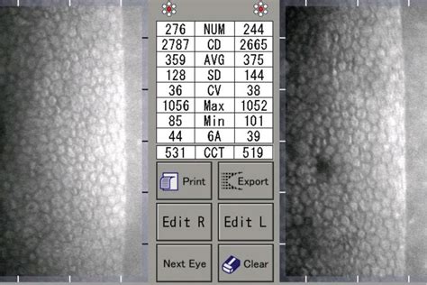 What Specular Microscopy Reveals About Your Patients