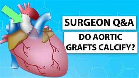 Surgeon Q&A: Can Dacron Grafts Calcify After Bicuspid Aortic Valve ...