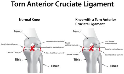 ACL Reconstruction Surgery | Ambulatory Surgical Center of Stevens Point