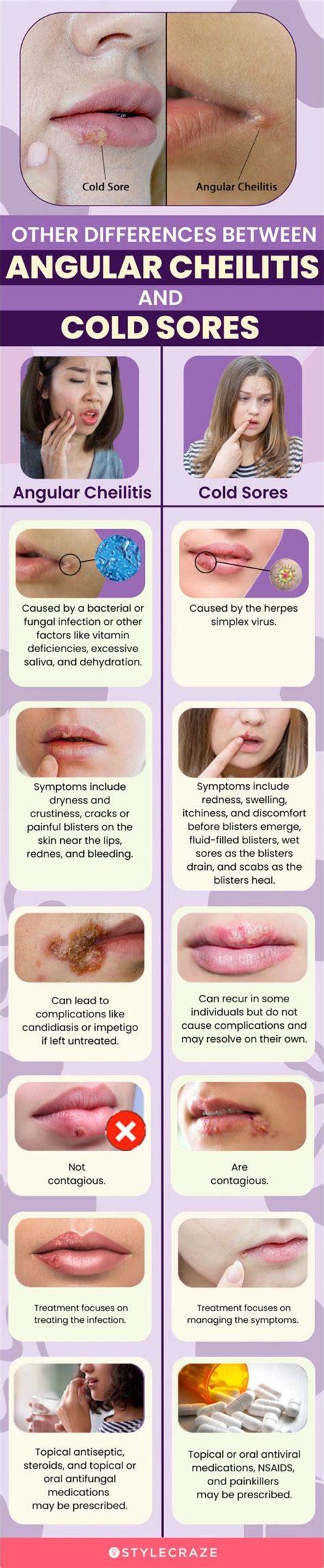 14 Remedies For Angular Cheilitis, Stages, Causes, & Prevention