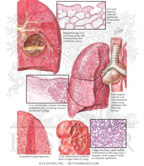 Congenital Bronchogenic and Pulmonary Cysts