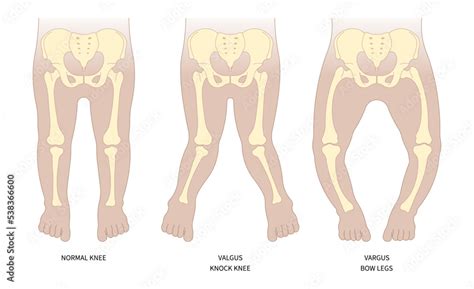 Classification of hip low density lack of vitamin D with rickets Blount's and Paget's disease x ...