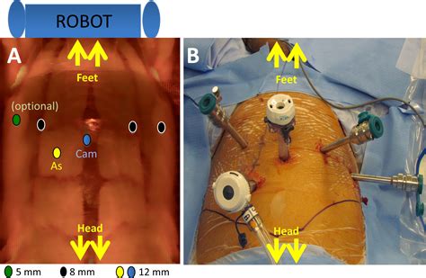 Transvesical Robotic Simple Prostatectomy: Initial Clinical Experience - European Urology