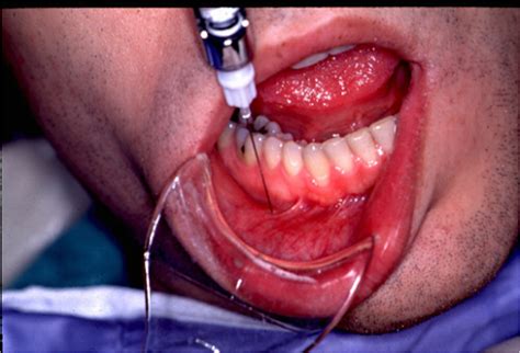 Nerve Blocks of the Face and Mouth — Downeast Emergency Medicine