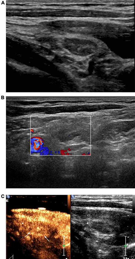 Frontiers | Value of Contrast-Enhanced Ultrasound in the Ultrasound ...