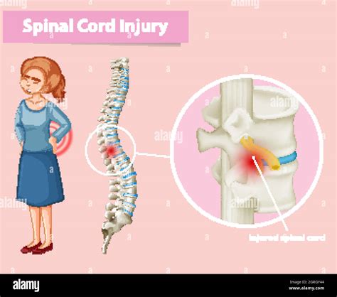 Diagram showing spinal cord injury in human Stock Vector Image & Art ...