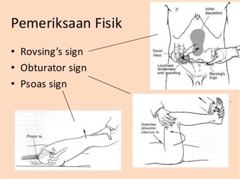 Psoas And Obturator Sign