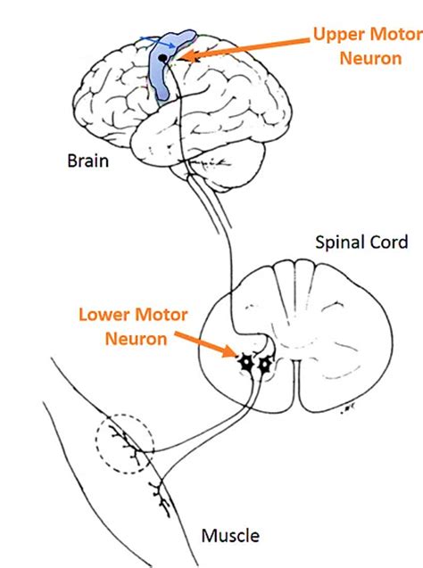 Upper and Lower Motor Neuron – Lesions – Anatomy QA