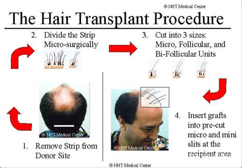 Hair transplant procedure - Hair Transplant