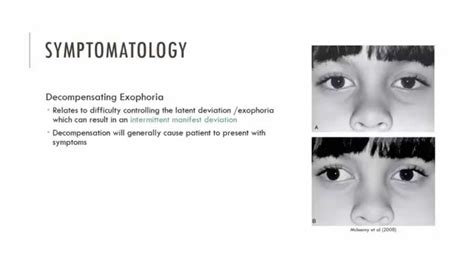 無料ダウンロード intermittent exotropia causes 341895-Causes of intermittent exotropia - Apictnyohbchh