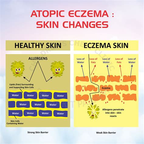 Atopic Dermatitis/ Eczema - Dr. Ankit Parakh