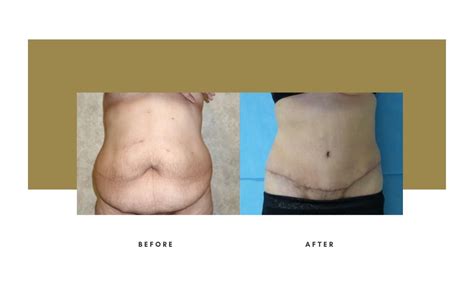 Abdominoplasty Beverly Hills | Julie Edween D.O.