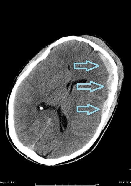 Subdural hematoma CT - wikidoc